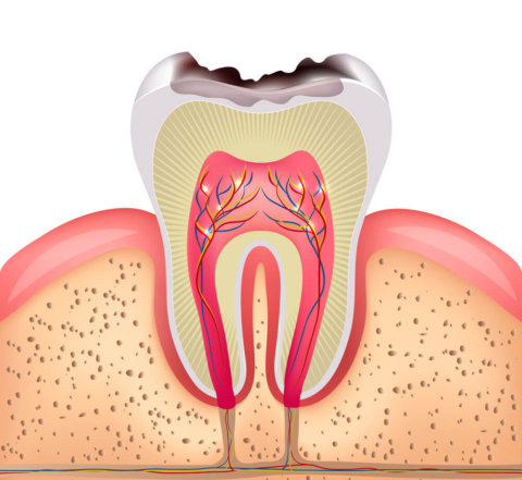 caries