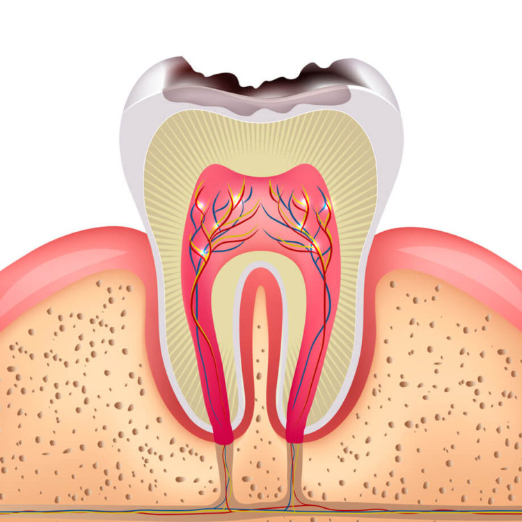 caries