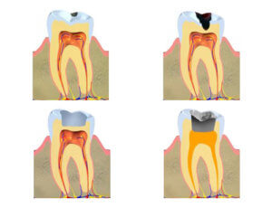 Evolución caries