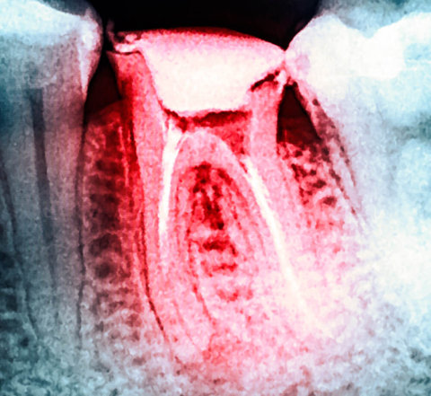endodoncia
