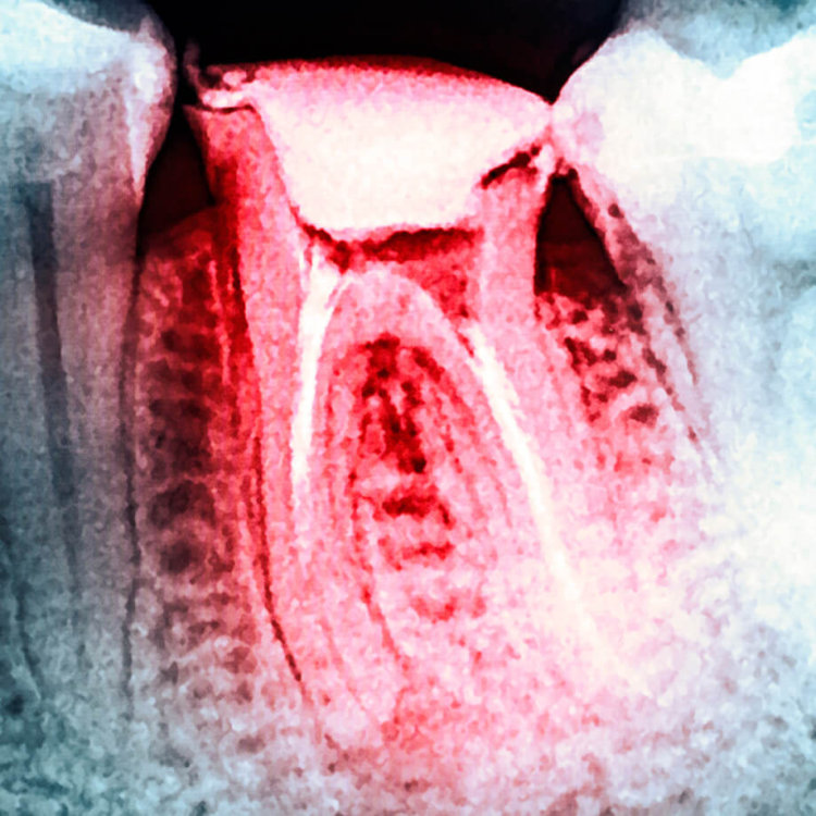 endo