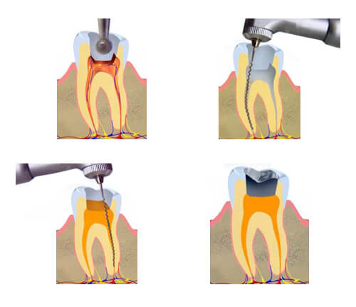 endodoncia tratamiento