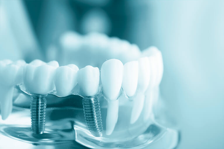 Síntomas de rechazo de un implante dental