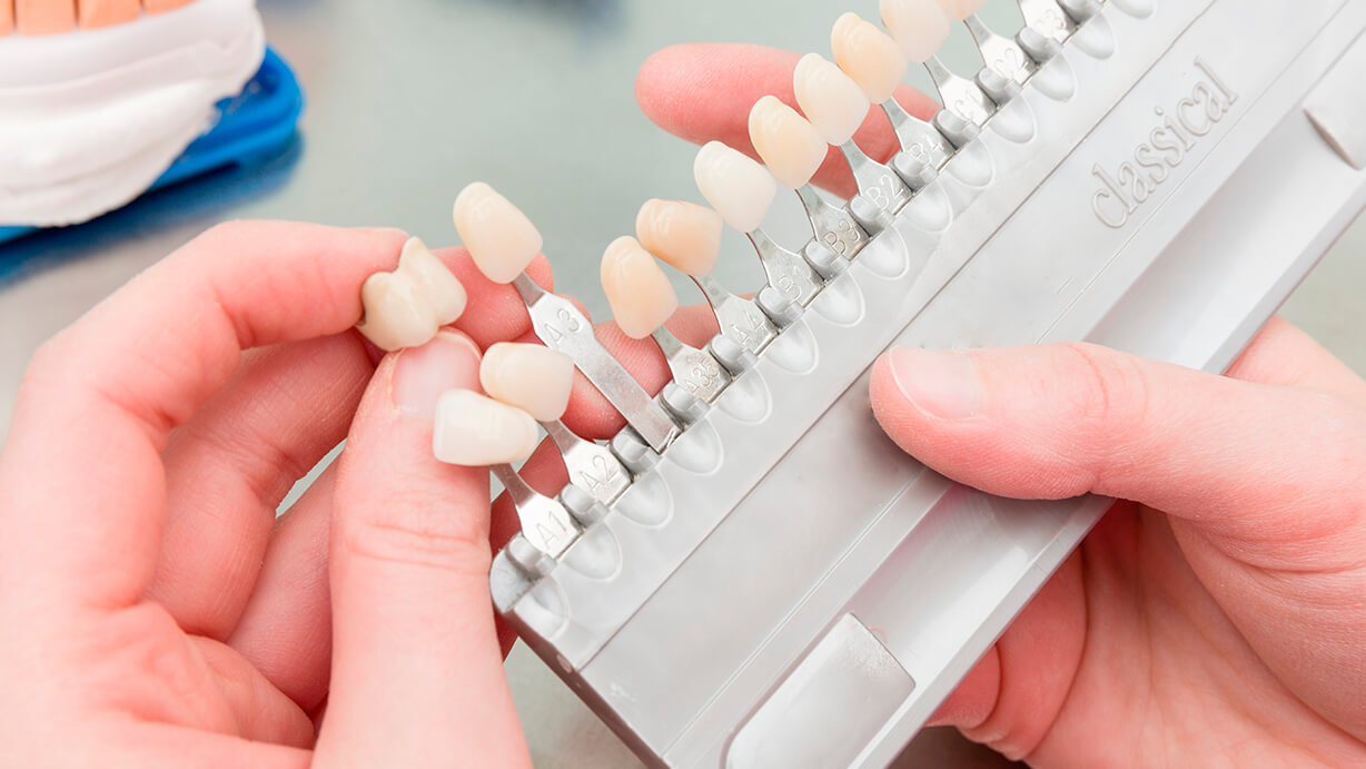Cómo cuidar las carillas dentales