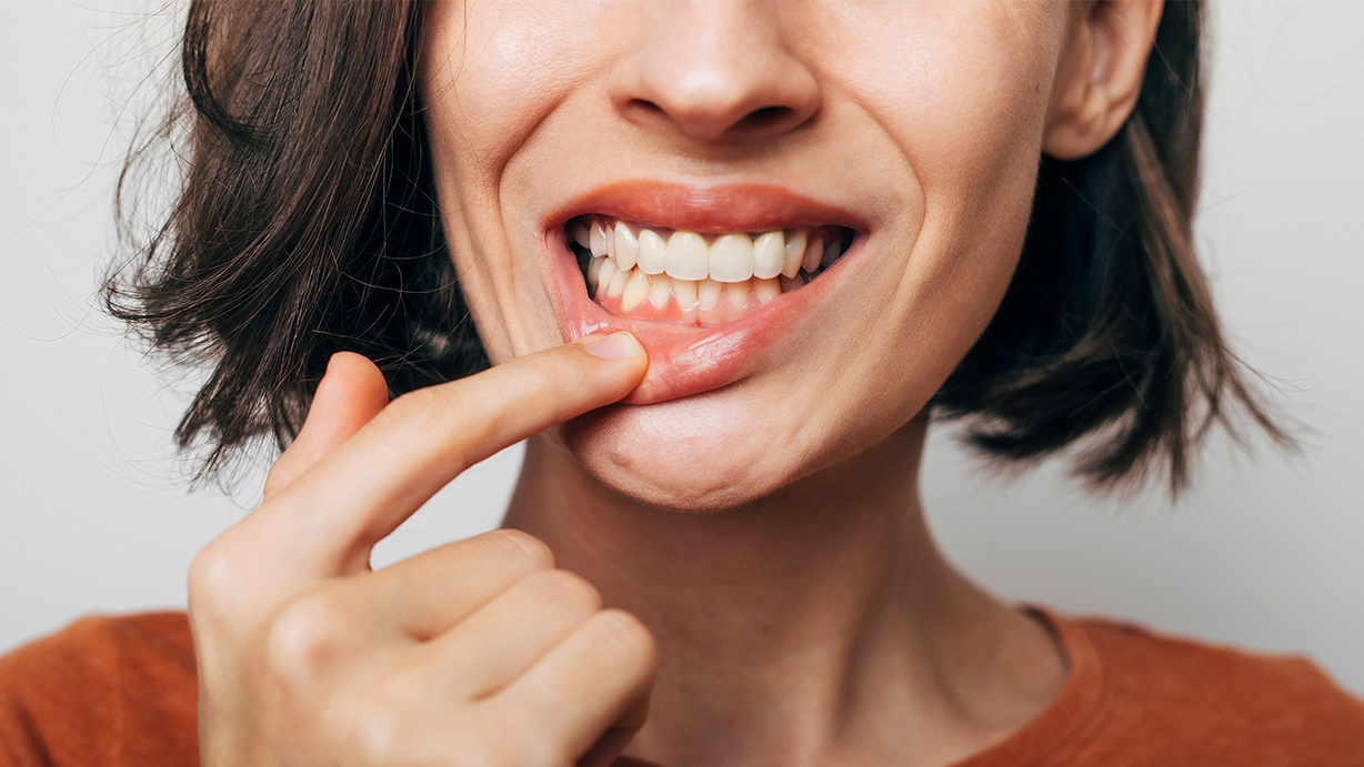 Diferencia entre gingivectomía y gingivoplastia