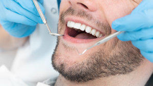 Tartrectomía dental: ¿qué es?