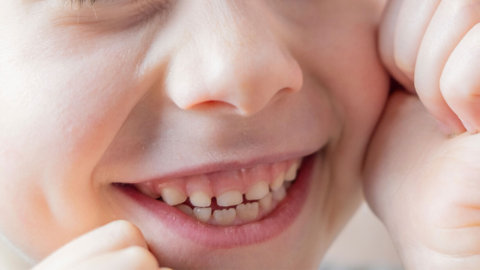 Mordida cruzada niños: causas y tratamientos