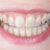 Dientes transparentes: causas y tratamientos