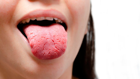 Lengua geográfica: tratamiento y cuidados recomendados