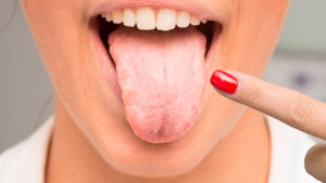 Muguet o candidiasis oral: causas, síntomas y tratamiento