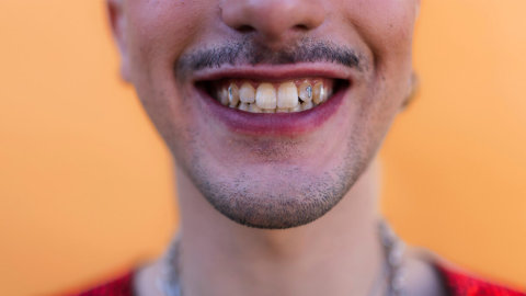 Grillz dentales: todo lo que debes saber