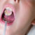 Protrusión dental: causas y tratamientos