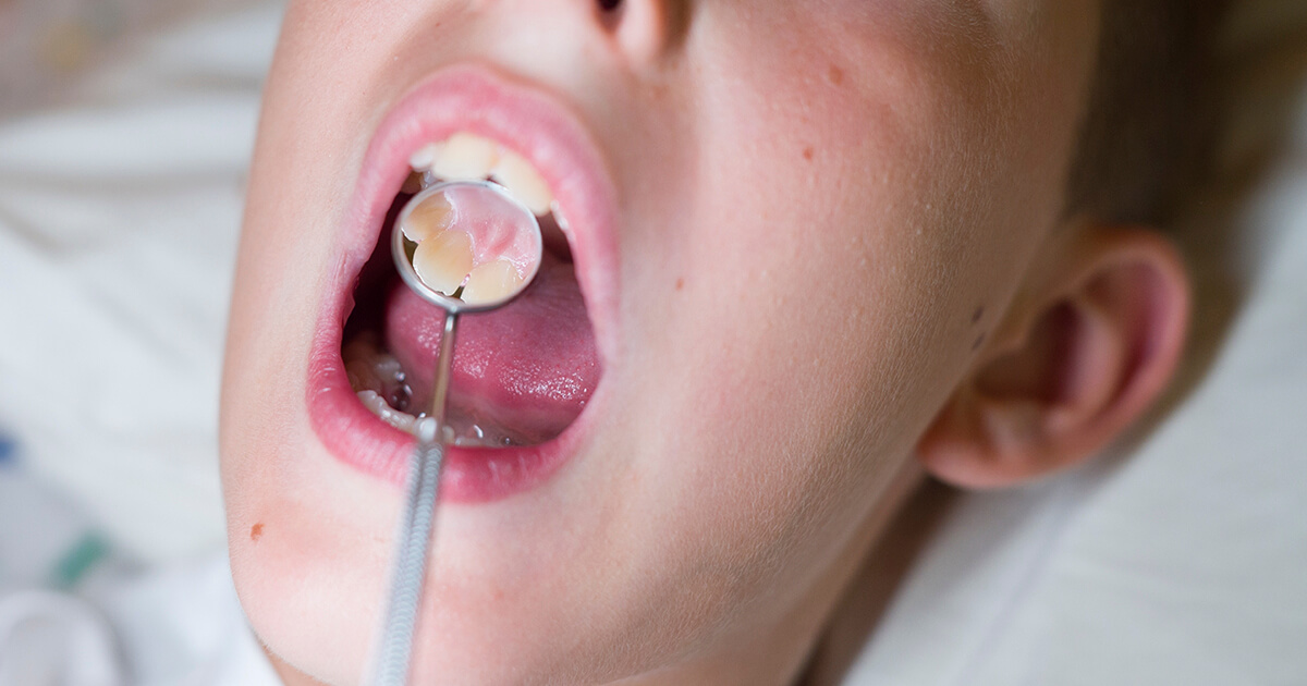 Protrusión dental: causas y tratamientos
