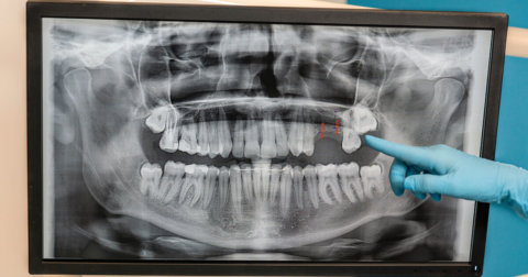 Reabsorción radicular: qué tipos hay y cómo se trata